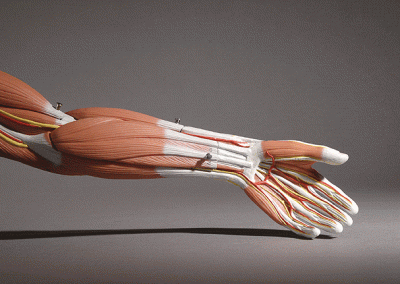 Model of a human arm used to defend an orthopaedic surgeon in a medical malpractice case.