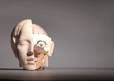A model of a human head utilized during a recent case involving brain injuries and neurosurgery.